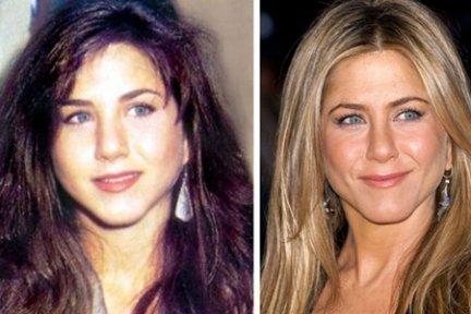 Jennifer Aniston confessa: ho fatto uso di botox