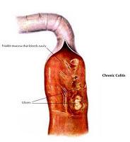 MALATTIE INFIAMMATORIE INTESTINALI (IBD)NEL CANE