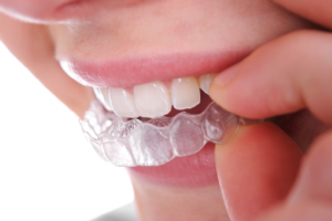 Manutenzione  Invisalign  – pulizia -