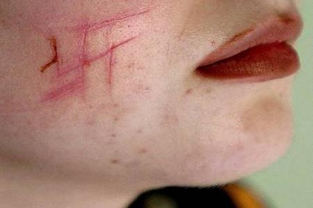 15 anni aggrdita in germania tagli a svastica sul viso Germania, aggredita 15enne, tagliuzzata con svastiche sul viso e sul sedere