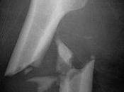 Osteoporosi: farmaci evitare nuove fratture