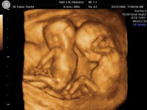 Gli abortisti in affanno osteggiano l’uso dell’ecografia 4D