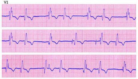 elettrocardiogramma-infarto_