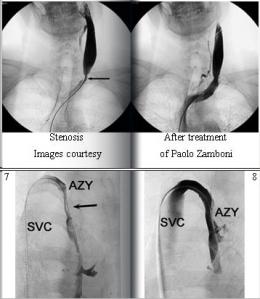 la Ccsvi (insufficienza venosa cerebro-spinale cronica) e l’angioplastica venosa nella sclerosi multipla meritano ulteriore attenzione